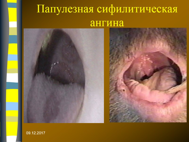 09.12.2017 Папулезная сифилитическая ангина